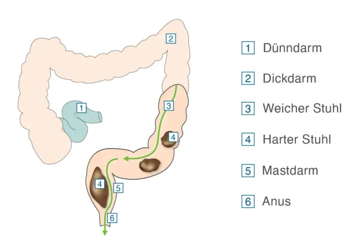 Darstellung des Verdauungstrakts. Ein grüner Pfeil zeigt den Weg des Stuhls durch den Dickdarm, wo sich harter Stuhl (4) bildet, was auf eine low carb verstopfung hindeuten kann.